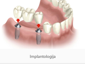 implantologija