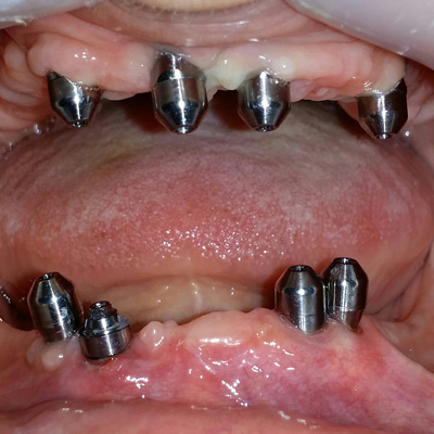 Implantologija 3